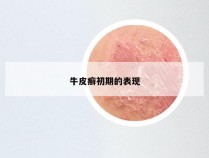 牛皮癣初期的表现
