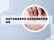 南昌牛皮癣疾病专家 南昌银屑病医院肤康 贴吧