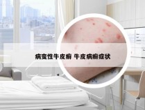 病变性牛皮癣 牛皮病癣症状