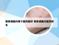 银屑病国内哪个医院最好 银屑病国内医院排名