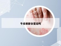 牛皮癣都会蔓延吗