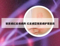 银屑病红皮病病例 红皮病型银屑病护理查房