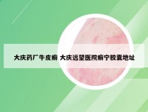 大庆药厂牛皮癣 大庆远望医院癣宁胶囊地址
