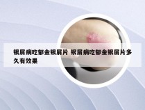 银屑病吃郁金银屑片 银屑病吃郁金银屑片多久有效果