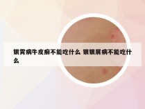 银霄病牛皮癣不能吃什么 银银屑病不能吃什么