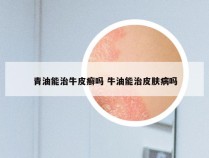 青油能治牛皮癣吗 牛油能治皮肤病吗