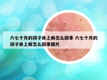 六七个月的孩子身上癣怎么回事 六七个月的孩子身上癣怎么回事图片
