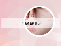 牛皮癣怎样忌口