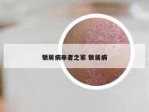 银屑病串者之家 银屑病