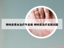 柳树皮煮水治疗牛皮癣 柳树皮治疗皮肤问题
