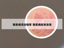 银屑病浸润增厚 银屑病皮损渗液
