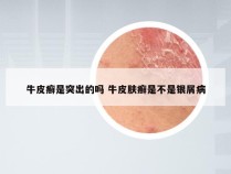 牛皮癣是突出的吗 牛皮肤癣是不是银屑病