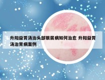 升阳益胃汤治头部银屑病如何治愈 升阳益胃汤治胃病案例