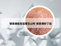 银屑病痊愈后要忌口吗 银屑病好了后