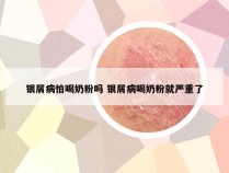 银屑病怕喝奶粉吗 银屑病喝奶粉就严重了