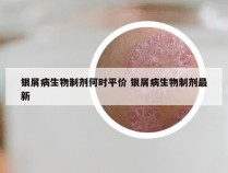 银屑病生物制剂何时平价 银屑病生物制剂最新