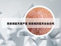 银屑病夏天更严重 银屑病到夏天会自愈吗