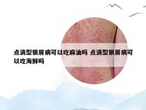 点滴型银屑病可以吃麻油吗 点滴型银屑病可以吃海鲜吗