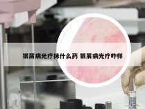 银屑病光疗抹什么药 银屑病光疗咋样