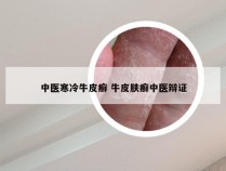 中医寒冷牛皮癣 牛皮肤癣中医辩证