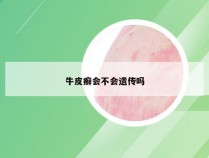 牛皮癣会不会遗传吗