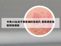 中央10台关于银屑病的免疫药 银屑病免疫制剂有哪些