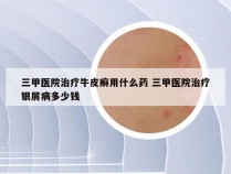三甲医院治疗牛皮癣用什么药 三甲医院治疗银屑病多少钱