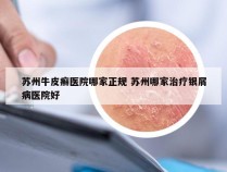 苏州牛皮癣医院哪家正规 苏州哪家治疗银屑病医院好