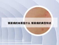 银屑病的本质是什么 银屑病的典型特点