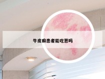 牛皮癣患者能吃葱吗