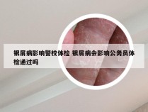 银屑病影响警校体检 银屑病会影响公务员体检通过吗