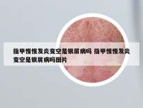 指甲慢慢发炎变空是银屑病吗 指甲慢慢发炎变空是银屑病吗图片