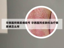 华西医院银屑病挂号 华西医院皮肤科治疗银屑病怎么样