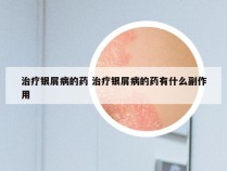 治疗银屑病的药 治疗银屑病的药有什么副作用
