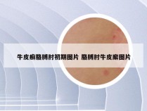 牛皮癣胳膊肘初期图片 胳膊肘牛皮廨图片
