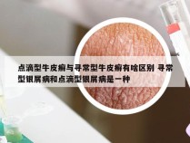 点滴型牛皮癣与寻常型牛皮癣有啥区别 寻常型银屑病和点滴型银屑病是一种