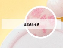 银屑病在龟头