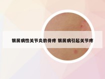 银屑病性关节炎肋骨疼 银屑病引起关节疼