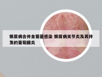 银屑病合并金葡菌感染 银屑病关节炎及其伴发的葡萄膜炎