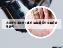 洁肤膏可以治疗牛皮癣 洁肤美灵可以治疗银屑病吗