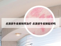 点滴状牛皮癣如何治疗 点滴状牛皮鲜能好吗