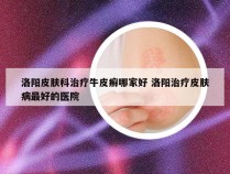 洛阳皮肤科治疗牛皮癣哪家好 洛阳治疗皮肤病最好的医院