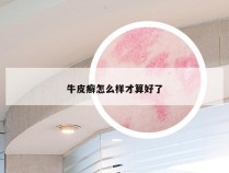 牛皮癣怎么样才算好了