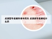 点滴型牛皮癣外用中药方 点滴状牛皮癣吃什么药