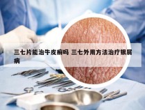 三七片能治牛皮癣吗 三七外用方法治疗银屑病