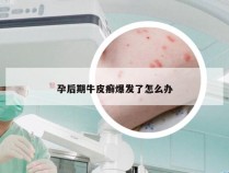 孕后期牛皮癣爆发了怎么办