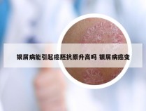 银屑病能引起癌胚抗原升高吗 银屑病癌变