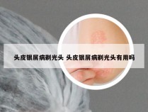 头皮银屑病剃光头 头皮银屑病剃光头有用吗
