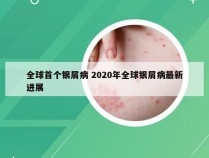 全球首个银屑病 2020年全球银屑病最新进展