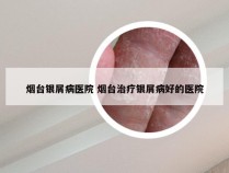 烟台银屑病医院 烟台治疗银屑病好的医院
